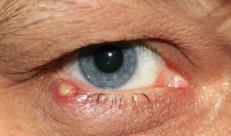 Babské rady na zánět oka: Jak přirozeně léčit oční infekce