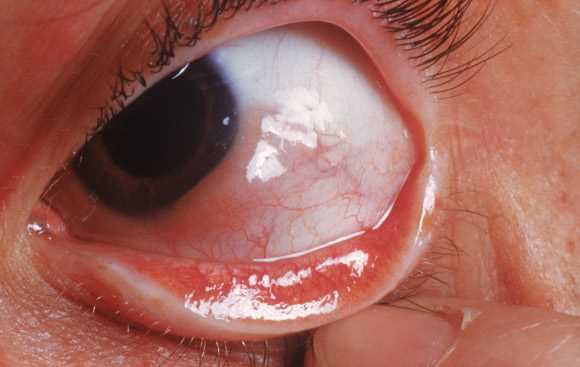 Babské rady na zánět oka: Jak přirozeně léčit oční infekce