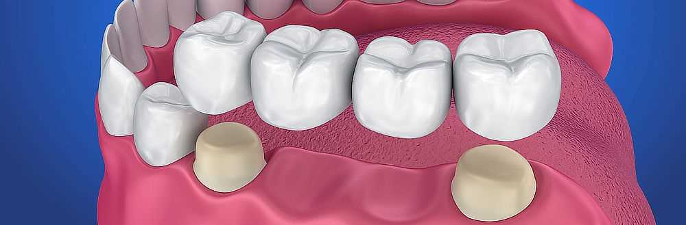Cena hybridní zubní náhrady: Co očekávat a jaké jsou možnosti