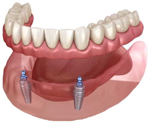 Cena odnímatelné zubní náhrady - nejlepší náklady na zubní protézy