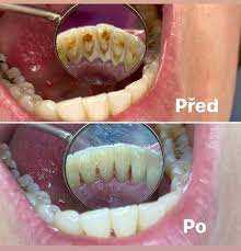Dentální hygiena před a po: Jak pečovat o zuby správně