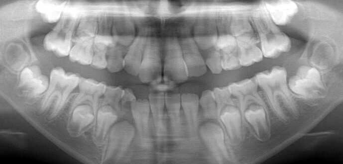 Jak dlouho roste zub: vývoj zubů od dětství do dospělosti
