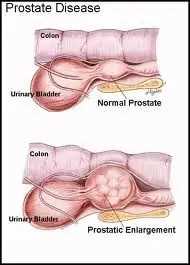 Jak se léčí zvětšená prostata | Léčba a prevence