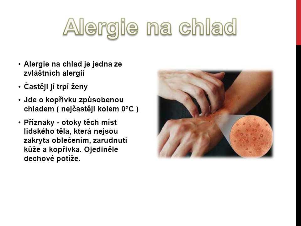 Alergie na chlad: příznaky, příčiny a léčba alergie na chlad
