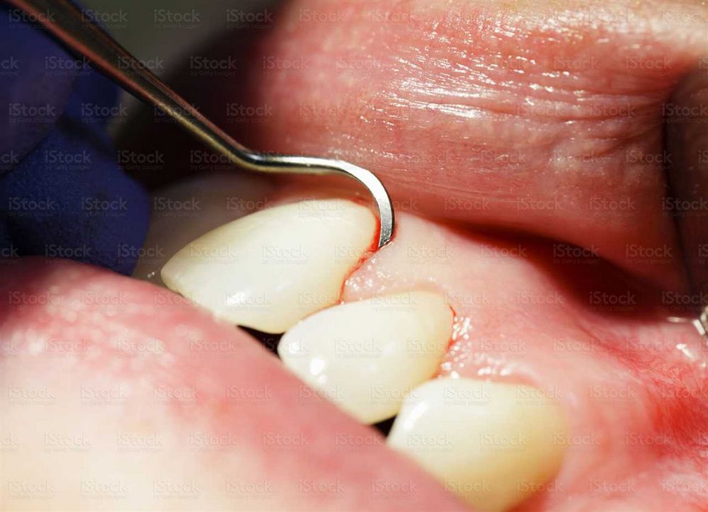 Otok dásní kolem zubů - příčiny, příznaky a léčba