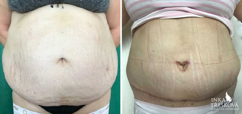 Abdominoplastika hrazená pojišťovnou: Jak získat finanční podporu pro plastickou operaci břicha Abdominoplastika hrazená pojišťovnou: Jak získat finanční podporu pro plastickou operaci břicha