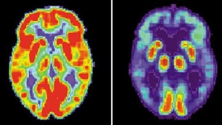 Alzheimerův test: Jak na něj a jaké jsou výsledky