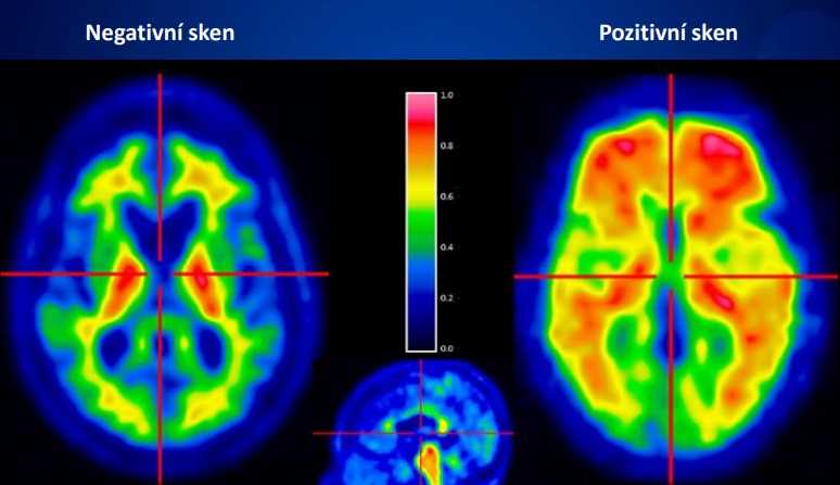 Alzheimerův test: Jak na něj a jaké jsou výsledky