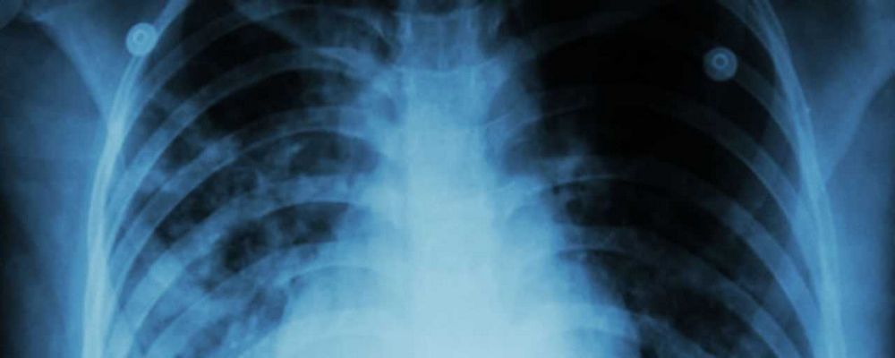 Antibiotika na zápal plic: Vše, co potřebujete vědět Antibiotika na zápal plic: Vše, co potřebujete vědět