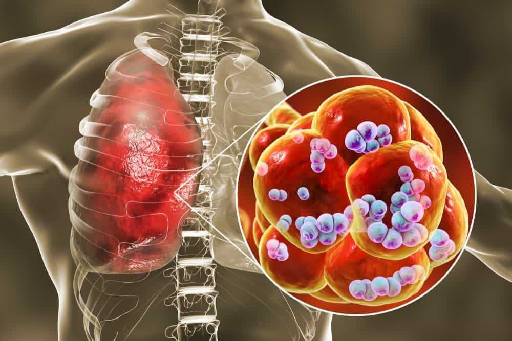 Antibiotika na zápal plic: Vše, co potřebujete vědět Antibiotika na zápal plic: Vše, co potřebujete vědět
