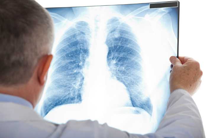 Antibiotika na zápal plic: Vše, co potřebujete vědět Antibiotika na zápal plic: Vše, co potřebujete vědět