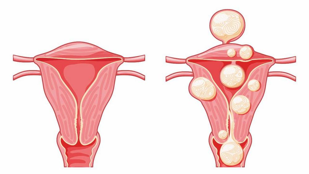 Babské rady na myomy: Jak přirozeně zvládat toto gynekologické onemocnění