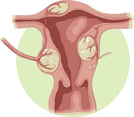 Babské rady na myomy: Jak přirozeně zvládat toto gynekologické onemocnění