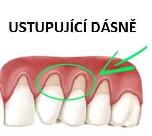 Babské rady na oteklé dásně - jak se s nimi vypořádat?