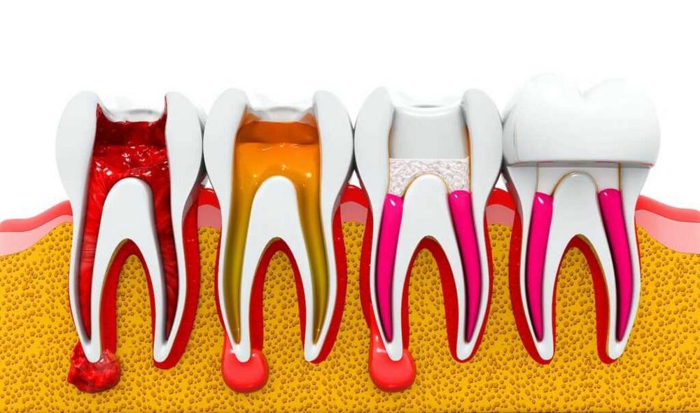 Cena endodontického ošetření - nejlepší ceny a kvalita | Náš web