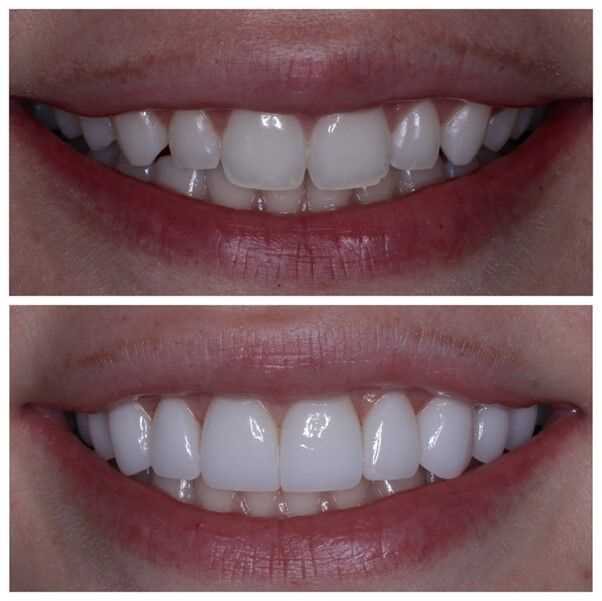 Cena faset na přední zuby - nejlepší volba pro úsměv