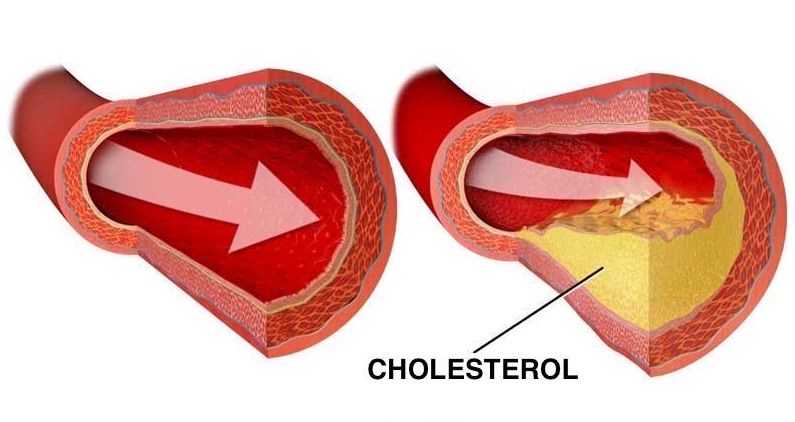 Co je cholesterol - příčiny, příznaky a prevence | Tipy a rady
