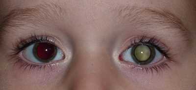 Černá tečka v oku příčiny, symptomy a léčba