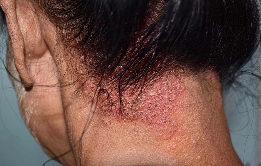 Červená kůže ve vlasech příčiny, léčba a prevence