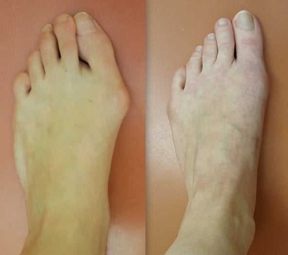 Moderní a efektivní metoda léčby haluxu laserem - Červen 2025 ...