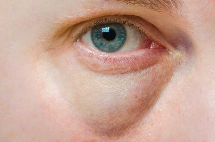 Fialové kruhy pod očima - Příčiny, léčba a prevence