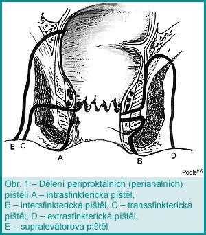 Píštěl na kostrči - příčiny, symptomy a léčba | Návod a tipy Píštěl na kostrči - příčiny, symptomy a léčba | Návod a tipy