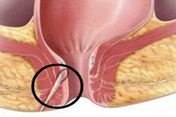 Píštěl na kostrči - příčiny, symptomy a léčba | Návod a tipy Píštěl na kostrči - příčiny, symptomy a léčba | Návod a tipy