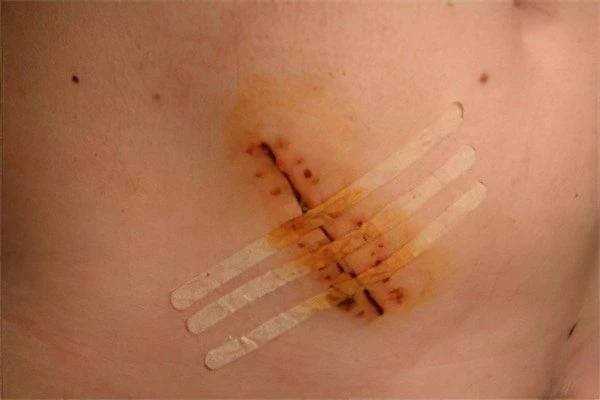 Píštěl na kostrči - příčiny, symptomy a léčba | Návod a tipy Píštěl na kostrči - příčiny, symptomy a léčba | Návod a tipy