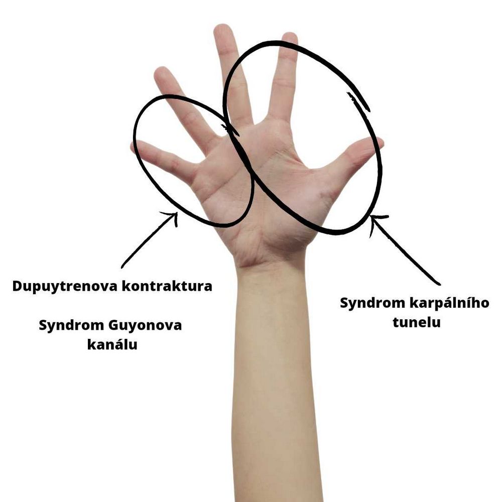 Bolest při ohýbání prstů: příčiny, příznaky a léčba