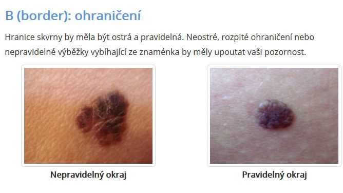Kde si nechat vyšetřit znaménka | Odborné vyšetření a odstranění znamének