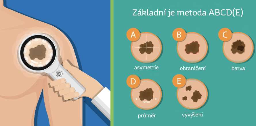 Kde si nechat vyšetřit znaménka | Odborné vyšetření a odstranění znamének