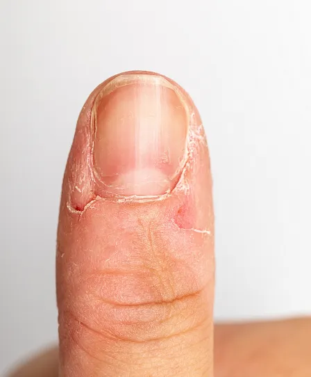 Následky kousání nehtů: jaké problémy to může způsobit a jak se s nimi vypořádat Následky kousání nehtů: jaké problémy to může způsobit a jak se s nimi vypořádat