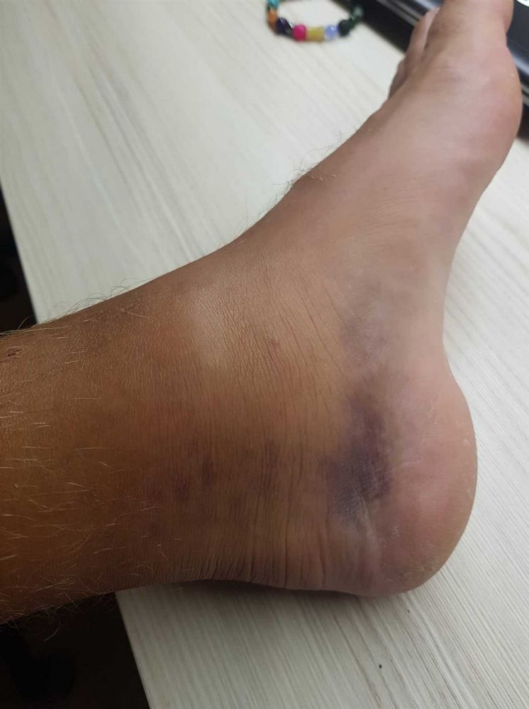 Neléčený výron kotníku - příčiny, symptomy a léčba | Návod a rady Neléčený výron kotníku - příčiny, symptomy a léčba | Návod a rady