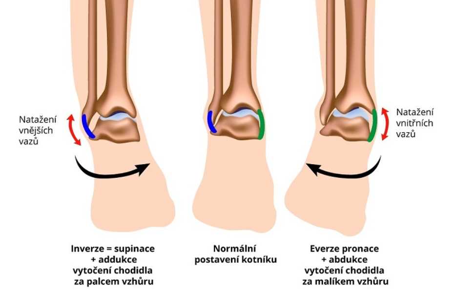 Neléčený výron kotníku - příčiny, symptomy a léčba | Návod a rady Neléčený výron kotníku - příčiny, symptomy a léčba | Návod a rady