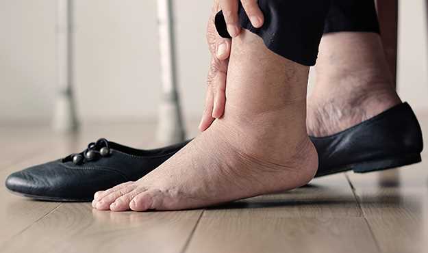 Oteklé kotníky a rty - příčiny, symptomy a léčba Oteklé kotníky a rty - příčiny, symptomy a léčba