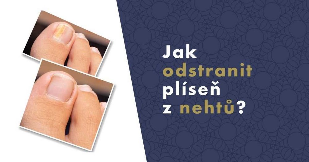 Přípravek na plíseň nehtů - účinná řešení a prevence