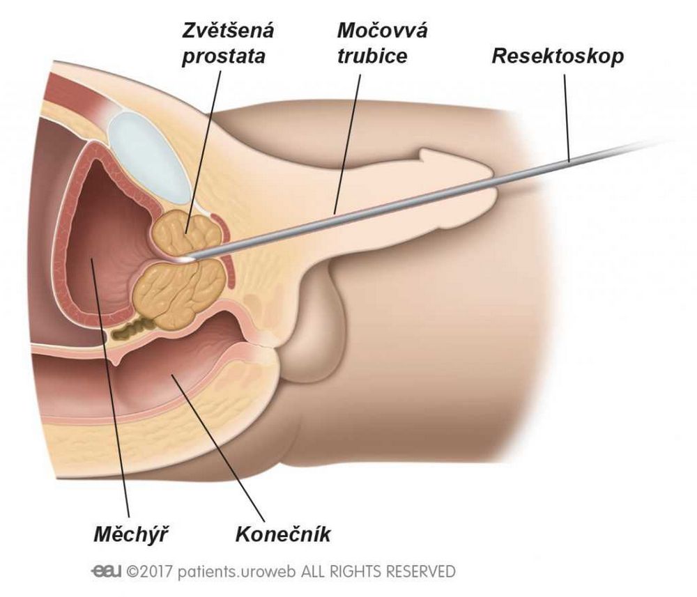 Pomočování po operaci prostaty: Jak se s tím vypořádat