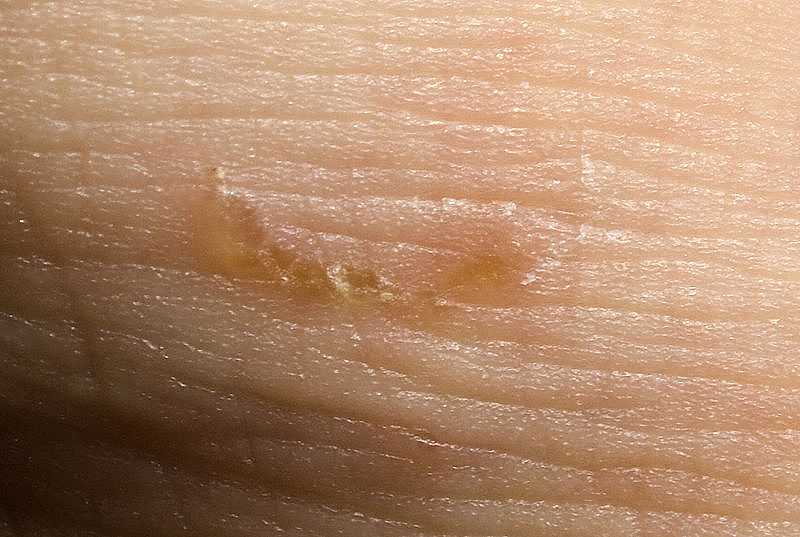 Svrab u dětí: foto, příznaky, léčba a prevence