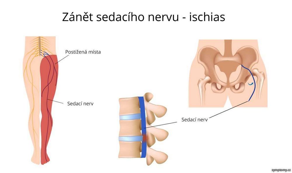 Ischias co to je příznaky příčiny a léčba - vše, co potřebujete vědět Ischias co to je příznaky příčiny a léčba - vše, co potřebujete vědět
